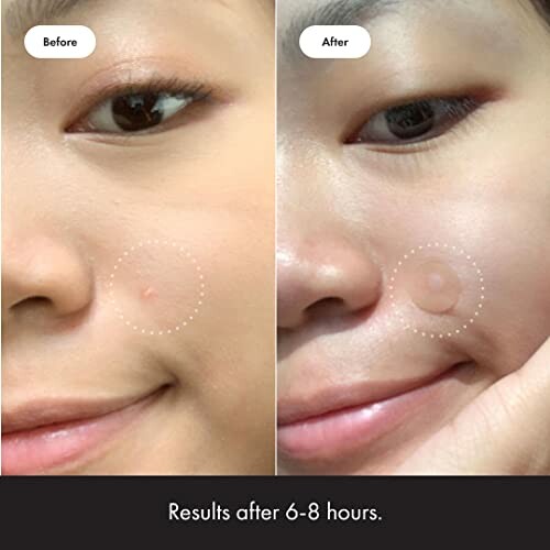 Close-up of a face showing acne treatment results with a noticeable improvement after 6-8 hours.