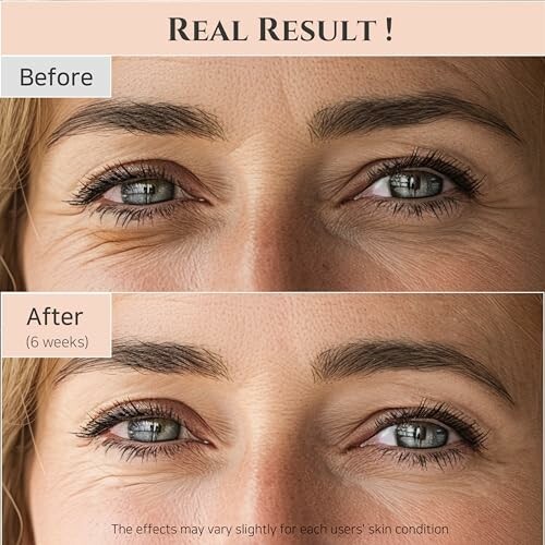 Before and after results of anti-aging eye treatment showing reduced wrinkles.