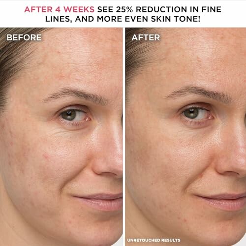 Comparison of skin before and after treatment showing reduced fine lines.