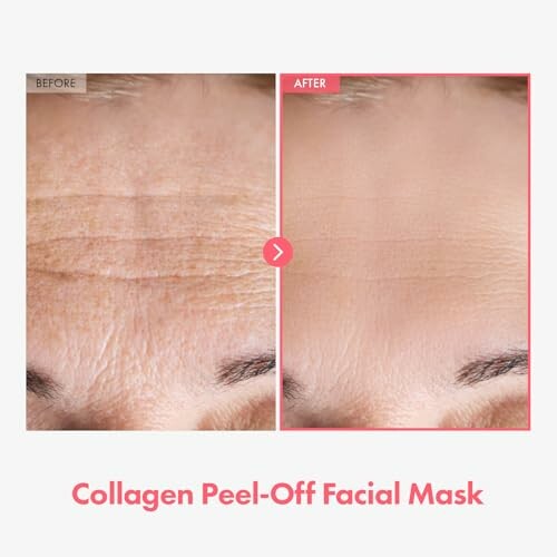 Before and after effects of collagen peel-off facial mask on forehead wrinkles.