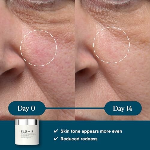 Side-by-side comparison of skin improvement from day 0 to day 14 with reduced redness.