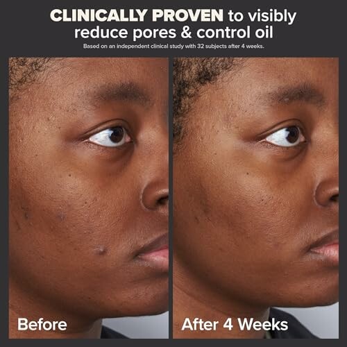 Before and after skincare treatment showing reduced pores and oil control.